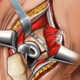 Hip Surgery Simulation Icon Image