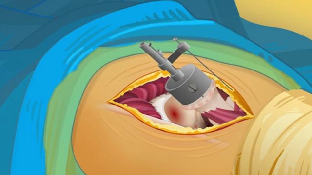 Hip Surgery Simulation Screenshot Image